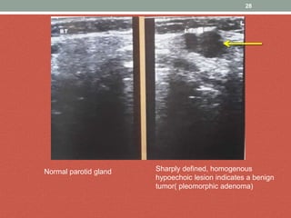 28
Normal parotid gland Sharply defined, homogenous
hypoechoic lesion indicates a benign
tumor( pleomorphic adenoma)
 