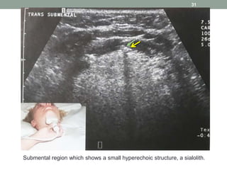 31
Submental region which shows a small hyperechoic structure, a sialolith.
 