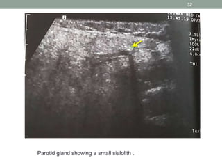 32
Parotid gland showing a small sialolith .
 