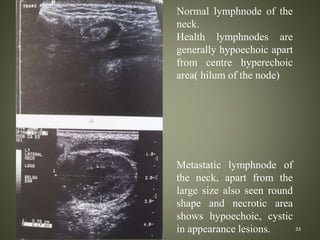 33
Normal lymphnode of the
neck.
Health lymphnodes are
generally hypoechoic apart
from centre hyperechoic
area( hilum of the node)
Metastatic lymphnode of
the neck, apart from the
large size also seen round
shape and necrotic area
shows hypoechoic, cystic
in appearance lesions.
 