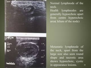 33
Normal lymphnode of the
neck.
Health lymphnodes are
generally hypoechoic apart
from centre hyperechoic
area( hilum of t...