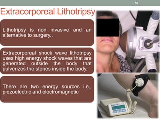 Extracorporeal Lithotripsy
Lithotripsy is non invasive and an
alternative to surgery..
Extracorporeal shock wave lithotripsy
uses high energy shock waves that are
generated outside the body that
pulverizes the stones inside the body.
There are two energy sources i.e.,
piezoelectric and electromagnetic
50
 