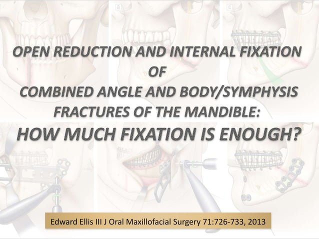 OPEN REDUCTION AND INTERNAL FIXATION OF COMBINED ANGLE AND BODY ...
