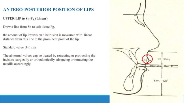 COGS Burstone analysis for orthognathic surgery | PPTX