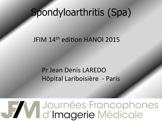Spondyloarthritis (Spa)	
  
JFIM	
  14th	
  edi-on	
  HANOI	
  2015	
  
Pr	
  Jean	
  Denis	
  LAREDO	
  
Hôpital	
  Lariboisière	
  	
  -­‐	
  Paris	
  	
  
 