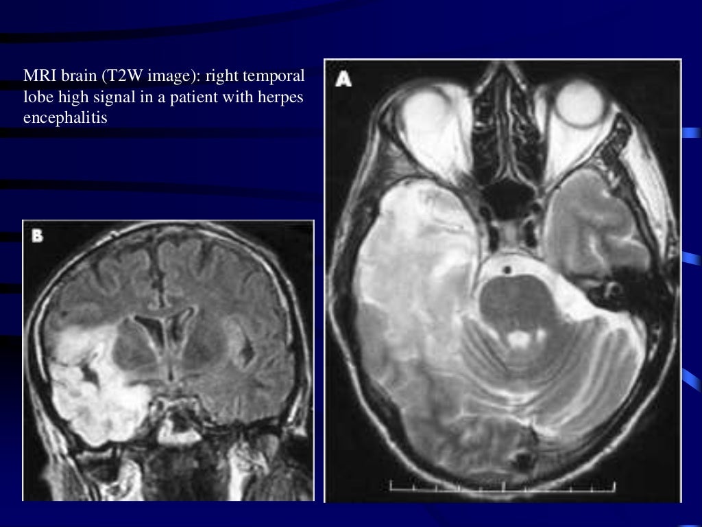 Japanese B encephalitis - Japanese B Encephalitis 25 1024 