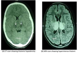 (A) CT scan showing thalamic hypodensity (B) MRI scan showing hyperintense thalami
 