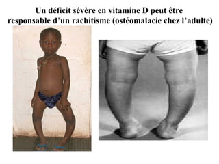 Un déficit sévère en vitamine D peut être  responsable d’un rachitisme (ostéomalacie chez l’adulte) 