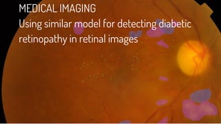 MEDICAL IMAGING
Using similar model for detecting diabetic
retinopathy in retinal images
 
