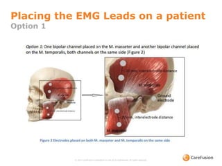 Placing the EMG Leads on a patient
Option 1
© 2015 CareFusion Corporation or one of its subsidiaries. All rights reserved.
 