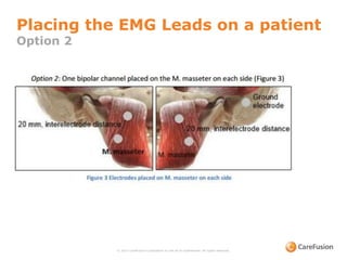 © 2015 CareFusion Corporation or one of its subsidiaries. All rights reserved.
Placing the EMG Leads on a patient
Option 2
 