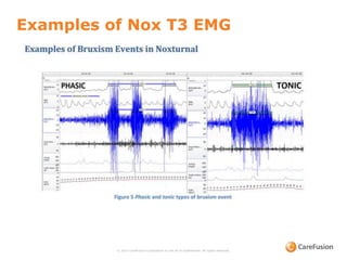 Examples of Nox T3 EMG
© 2015 CareFusion Corporation or one of its subsidiaries. All rights reserved.
 