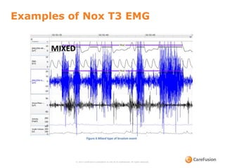 Examples of Nox T3 EMG
© 2015 CareFusion Corporation or one of its subsidiaries. All rights reserved.
 