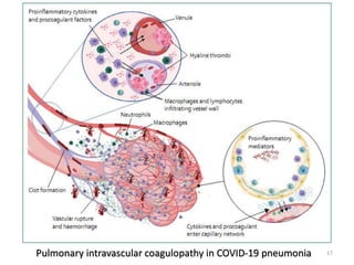 Pulmonary intravascular coagulopathy in COVID-19 pneumonia 17
 