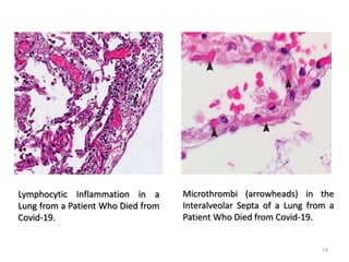Lymphocytic Inflammation in a
Lung from a Patient Who Died from
Covid-19.
Microthrombi (arrowheads) in the
Interalveolar Septa of a Lung from a
Patient Who Died from Covid-19.
19
 