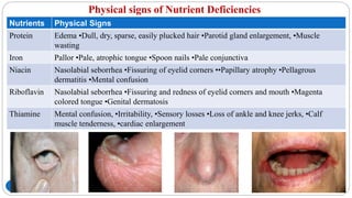 Physical signs of Nutrient Deficiencies
112
Nutrients Physical Signs
Protein Edema •Dull, dry, sparse, easily plucked hair •Parotid gland enlargement, •Muscle
wasting
Iron Pallor •Pale, atrophic tongue •Spoon nails •Pale conjunctiva
Niacin Nasolabial seborrhea •Fissuring of eyelid corners ••Papillary atrophy •Pellagrous
dermatitis •Mental confusion
Riboflavin Nasolabial seborrhea •Fissuring and redness of eyelid corners and mouth •Magenta
colored tongue •Genital dermatosis
Thiamine Mental confusion, •Irritability, •Sensory losses •Loss of ankle and knee jerks, •Calf
muscle tenderness, •cardiac enlargement
 