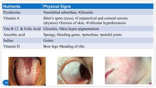 113
Nutrients Physical Signs
Pyridoxine Nasolabial seborrhea, •Glossitis
Vitamin A Bitot’s spots (eyes), •Conjunctival and corneal xerosis
(dryness) •Xerosis of skin, •Follicular hyperkeratosis
Vita B 12 & Folic Acid Glossitis, •Skin hyper pigmentation
Ascorbic acid Spongy, bleeding gums, •petechiae, •painful joints
Iodine Goitre
Vitamin D Bow legs •Beading of ribs
 