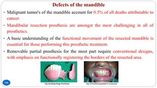 Defects of the mandible
156
• Malignant tumor's of the mandible account for 0.5% of all deaths attributable to
cancer.
• Mandibular resection prosthesis are amongst the most challenging in all of
prosthetics.
• A basic understanding of the functional movement of the resected mandible is
essential for those performing this prosthetic treatment.
• Removable partial prosthesis for the most part require conventional designs,
with emphasis on functionally registering the borders of the resected area.
 