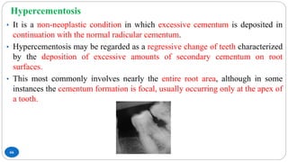 Hypercementosis
66
• It is a non-neoplastic condition in which excessive cementum is deposited in
continuation with the normal radicular cementum.
• Hypercementosis may be regarded as a regressive change of teeth characterized
by the deposition of excessive amounts of secondary cementum on root
surfaces.
• This most commonly involves nearly the entire root area, although in some
instances the cementum formation is focal, usually occurring only at the apex of
a tooth.
 