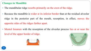 79
Changes in Mandible
• The mandibular ridge resorbs primarily on the crest of the ridge.
• Because the mandible is wider at its inferior border than at the residual alveolar
ridge in the posterior part of the mouth, resorption, in effect, moves the
opposite sides of the ridges farther apart.
• Mental foramen with the resorption of the alveolar process lies at or near the
level of the upper border of ridge.
 