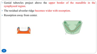 80
• Genial tubercles project above the upper border of the mandible in the
symphyseal region.
• The residual alveolar ridge becomes wider with resorption.
• Resorption away from center.
 