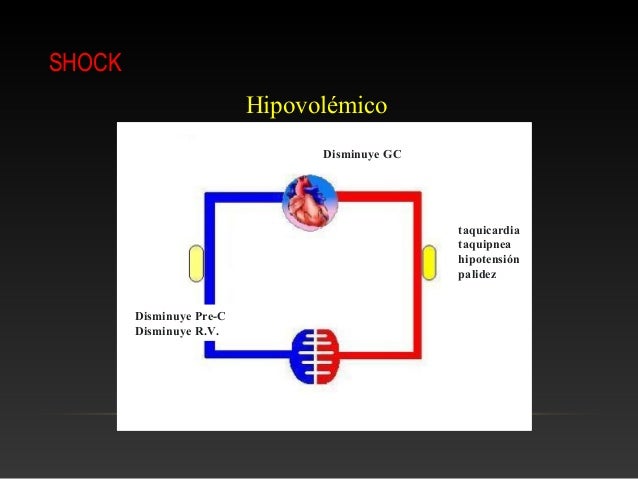 shock hipovolemico