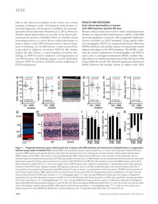 RESULTS AND DISCUSSION 
Early retinal abnormalities in humans 
with GRN mutations and Grn-KO mice 
Because retinal neuron loss occurs in other neurodegenerative 
diseases, we suspected that retinal neurons could be a vulnerable 
neuronal population in humans with progranulin haploinsuf­ficiency 
secondary to GRN mutations. Using optical coher-ence 
tomography (OCT), we measured retinal nerve fiber layer 
(RNFL) thickness and macular volume in living human control 
subjects and subjects with GRN mutations. The RNFL consti-tutes 
the axonal compartment of retinal ganglion cells (RGCs) 
and, as such, is a surrogate measurement of RGC number. Mac-ular 
volume is a combined measurement of all of the layers of the 
retina within the macula. We observed significant reductions in 
RNFL thickness and macular volume in subjects with GRN 
Due to the clinical accessibility of the retina, new retinal 
imaging techniques under development hold promise as 
potential diagnostic and prognostic modalities for neurode-generative 
diseases (Koronyo-Hamaoui et al., 2011). However, 
whether retinal abnormalities are an early or late disease phe-nomenon 
has not been established. Here, we identify retinal 
neurodegeneration as a novel disease-related phenotype in 
human subjects with GRN mutations before clinical symp-toms 
of dementia. In Grn-KO mouse, retinal neuronal loss 
is preceded by depletion of nuclear TDP-43. We further 
explore the role of Ran, a central regulator of nuclear traf-ficking, 
in TDP-43 nuclear depletion and degeneration in 
Grn-KO neurons. Our findings suggest a novel relationship 
between TDP-43 and Ran-mediated nuclear trafficking in 
FTLD pathogenesis. 
Figure 1. Progranulin deficiency causes retinal neuron loss in humans with GRN mutations and retinal neuron loss/dysfunction in a progranulin-deficient 
mouse model of familial FTLD. (A and B) RNFL thinning (A) and macular volume loss (B) occur in humans with progranulin haploinsufficiency 
caused by GRN mutations and precede dementia onset. Each dot represents value of an individual eye, and bars represent median values. Asymptomatic 
GRN-mutation carriers (CDR = 0) are shown in blue and symptomatic GRN mutation carriers (CDR score ≥ 0.5) are shown in red. Control age- and sex-matched 
subjects are represented by gray dots. (C–F) Macular ganglion cell loss occurs in GRN mutation carriers and precedes dementia onset. An automated 
segmentation algorithm (C) was used to determine the volumes of GCC (D), INL (E), and ONL (F) in the maculae of control and GRN mutation carriers (D–F). 
Results represent a single cohort of n = 24 control subjects and 12 GRN mutation carrier subjects (7 asymptomatic, 5 symptomatic), and p-values were gen-erated 
via mixed-effects linear regression analyses. (G) Progranulin expression occurs in the GCL and photoreceptor inner and outer segments (IS, OS) of 
mouse retinas. Immunostaining of progranulin and DAPI staining of nuclei are shown in a representative retinal cross section. (H) RNFL thinning and loss of 
inner retinal neurons shown in HE-stained retinal cross sections from 18-mo-old Grn KO mice. Representative sections equidistant to the optic nerve are 
shown. (I) Quantification of RNFL layer thickness. n = 5–7 mice/age/genotype; *, P  0.05, one-way ANOVA with Tukey’s post-hoc analysis, 2 independent 
experiments. (J) Loss of Neu-N–positive neurons in the GCL of 18-mo Grn KO retinas. Neu-N–positive cells in the GCL were quantified in sections equidistant 
to the optic nerve head. n = 5–7 mice/age/genotype; **, P  0.01, one-way ANOVA with Tukey’s post-hoc analysis, 2 independent experiments. (K) Impaired 
light-evoked RGC electrophysiological responses in aged Grn KO mice. Electroretinograms (ERGs) were performed on 12- and 18-mo-old mice, and the ampli-tude 
of the photopic-negative response (PhNR, a RGC-specific waveform) was quantified. n = 6 mice/age/genotype; ***, P  0.001 at 18 mo of age via re-peated 
measures two-way ANOVA with Bonferroni’s multiple comparison test; 2 independent experiments. Bars: (C, G, and H) 50 μm. 
1938 Retinal thinning and TDP-43 mislocalization in FTLD | Ward et al. 
 