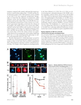 Br ief Def ini t ive Repor t 
in the brain (Ahmed et al., 2010; Yin et al., 2010), we ob-served 
progressive, substantial thinning of the RNFL and a 
loss of ganglion cell layer (GCL) cells in 18-mo-old Grn-KO 
mice (Fig. 1, H–J). In agreement with the pathological altera-tions, 
electrophysiological abnormalities in Grn-KO mouse 
retinas paralleled GCL neuron loss. At 18 mo, but not 12 mo, 
of age, Grn-KO mice had substantially reduced amplitudes 
of photopic negative responses (PhNRs), a measure of RGC 
function (Fig. 1 K). Amplitudes of a- and b-wave responses 
were also significantly reduced in an age-dependent manner 
in Grn-KO mice, indicating additional dysfunction of inner 
nuclear layer neurons and photoreceptors (unpublished data). 
Nuclear depletion of TDP-43 in Grn-KO 
retinal neurons precedes neurodegeneration 
Loss of nuclear TDP-43 is commonly observed in postmor-tem 
brain tissue from patients with FTLD-TDP (Neumann 
et al., 2006; Davidson et al., 2007), including FTLD associated 
with GRN mutations (Fig. 2 A). However, the mechanism of 
nuclear depletion of TDP-43 in FTLD is unknown, and it 
remains unclear if loss of nuclear TDP-43 plays a causal role in 
FTLD pathogenesis. At 18 mo of age, levels of nuclear TDP-43 
mutations compared with controls, indicating that retinal neu-ron 
loss occurred in these subjects (Fig. 1, A and B; and Fig. S1). 
A substantial number of the GRN mutation carriers enrolled 
in our trial (7/12) were cognitively asymptomatic. Intrigu-ingly, 
we found that this subgroup of asymptomatic GRN 
mutation carriers also had significant reductions in RNFL 
thickness and macular volume (Fig. 1, A and B). We then ana-lyzed 
individual neuronal layers of the macula via an auto-mated 
segmentation algorithm, to determine the volumes of 
the ganglion cell complex (GCC), inner nuclear layer (INL), 
and outer nuclear layer (ONL) in the maculae of control and 
GRN-mutation carriers (Fig. 1 C). Significant thinning of the 
GCC and INL, but not ONL, was observed in GRN muta-tion 
carriers (Fig. 1, D–F). The volume of GCC was signifi-cantly 
reduced even in asymptomatic carriers, further implicating 
RGC loss as an early neurodegenerative phenotype in sub-jects 
with progranulin deficiency (Fig. 1 D). 
We then determined if a similar phenotype occurred in 
Grn-KO mice. Total retinal progranulin expression levels were 
similar to those in the brain, based on ELISA (unpublished 
data), with prominent expression in RGCs and photorecep-tors 
(Fig. 1 G). Despite a lack of significant neurodegeneration 
Figure 2. Nuclear depletion of TDP-43 occurs in 
retinal neurons before neurodegeneration. (A) Post-mortem 
brain tissue from a human GRN mutation car-rier 
was co-stained with the nuclear marker DAPI (blue) 
and an anti–TDP-43 antibody (green). Normal TDP-43 
distribution is still observed in some neurons (arrow-head), 
but other neurons exhibit nuclear depletion of 
TDP43 (arrow) with or without apparent cytoplasmic 
inclusions. Bar, 10 μm. (B) Immunofluorescence confo-cal 
microscopy of TDP-43 in 18-mo-old retinal GCL 
neurons. Brightness of the TDP-43 channel was in-creased 
in insets to highlight loss of nuclear TDP-43 in 
Grn KO neurons. Bar, 1 μm. (C) Scatter plot of nuclear 
and cytoplasmic intensities of TDP-43 in GCL neurons 
of 18-mo-old Grn KO mice. n = 121–174 cells from 
6 mice/genotype; ***, P  0.001, mixed-effects multivari-ate 
linear regression mode; 2 independent experiments. 
Bars represent median values. (D) Significant reduction 
in the nuclear/cytoplasmic TDP-43 ratio was observed 
in 12-mo-old Grn-KO GCL neurons (**, P  0.01) and 
18-mo-old Grn-KO GCL neurons (**, P  0.01). n = 217–357 
cells from 5–7 mice/age/genotype, mixed-effects 
multivariable linear regression model; 2 independent 
experiments. Mean ± SEM is shown. 
JEM Vol. 211, No. 10 1939 
 