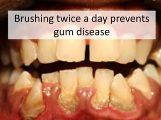 Brushing twice a day prevents
        gum disease
 