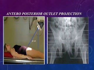 ANTERO POSTERIOR OUTLET PROJECTION
 