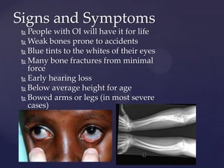 Signs and SymptomsPeople with OI will have it for lifeWeak bones prone to accidentsBlue tints to the whites of their eyesMany bone fractures from minimal forceEarly hearing lossBelow average height for ageBowed arms or legs (in most severe cases)