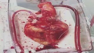 HEART TRANSPLANTATION SUGERY