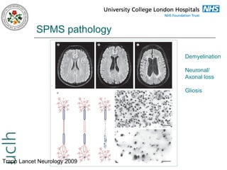 SPMS pathology
Demyelination
Neuronal/
Axonal loss
Gliosis

Trapp Lancet Neurology 2009

 