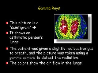 Gamma Rays
This picture is a
“scintigram” 
It shows an
asthmatic person’s
lungs.
The patient was given a slightly radioactive gas
to breath, and the picture was taken using a
gamma camera to detect the radiation.
The colors show the air flow in the lungs.
 