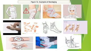 Figure 12. Examples of Bandaging
 