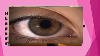 Physiological changes in size:
Pupils tend to dilate during
emotional stress and constrict
during sleep.
Pupillary unrest:
Refers to the constant fluctuation
in pupillary diameter under
normal environmental condition.
Hippus(jumping Pupil);
Exaggeration of the pupillary
unrest i.e. fluctuation in
pupillary diameter which can be
easily detected on visual
inspection without
magnification.
 