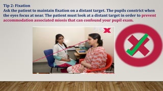 Tip 2: Fixation
Ask the patient to maintain fixation on a distant target. The pupils constrict when
the eyes focus at near. The patient must look at a distant target in order to prevent
accommodation associated miosis that can confound your pupil exam.
 