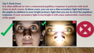 Tip 5: Dark Irises
It is often difficult to view a consensual pupillary response in patients with dark
irises in dark rooms. In these cases, you can use a dim secondary light held below
the pupils in addition to your bright primary light that you use to elicit the pupillary
response. If your secondary light is too bright it will cause undesirable constriction
of the pupil.
 