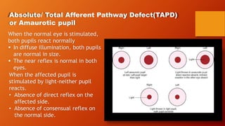 Absolute/ Total Afferent Pathway Defect(TAPD)
or Amaurotic pupil
When the normal eye is stimulated,
both pupils react normally
 In diffuse illumination, both pupils
are normal in size.
 The near reflex is normal in both
eyes.
When the affected pupil is
stimulated by light-neither pupil
reacts.
• Absence of direct reflex on the
affected side.
• Absence of consensual reflex on
the normal side.
 