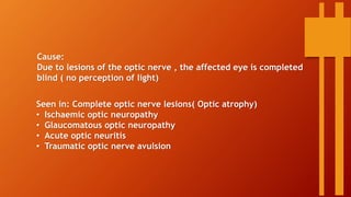 Cause:
Due to lesions of the optic nerve , the affected eye is completed
blind ( no perception of light)
Seen in: Complete optic nerve lesions( Optic atrophy)
• Ischaemic optic neuropathy
• Glaucomatous optic neuropathy
• Acute optic neuritis
• Traumatic optic nerve avulsion
 