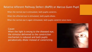 Relative Afferent Pathway Defect (RAPD) or Marcus-Gunn Pupil
When the normal eye is stimulated, both pupils constrict.
When the affected eye is stimulated, both pupils dilate.
When the normal eye is again stimulated, both pupils constrict once more.
Cause:
When the light is swung to the diseased eye,
the stimulus delivered to the constriction
mechanism is reduced and both pupils
paradoxically dilate instead of constricting.
 