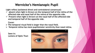 Wernicke’s Hemianopic Pupil
Light reflex( ipsilateral direct and contralateral consensual)
 absent when light is thrown on the temporal half of the retina of the
affected side and nasal half of the retina of the opposite side.
 Present when light is thrown on the nasal half of the affected side
and temporal half of the opposite side.
Cause:
 The temporal visual field is larger than the nasal field.
 Temporal retina has more pupillomotor sensitivity than nasal retina.
Seen in:
Lesions of Optic Tract
 