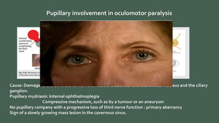 Pupillary involvement in oculomotor paralysis
Cause: Damage to the third cranial nerve at locations between the oculomotor nucleus and the ciliary
ganglion.
Pupillary mydriasis: Internal ophthalmoplegia
Compressive mechanism, such as by a tumour or an aneurysm
No pupillary company with a progressive loss of third nerve function : primary aberrancy
Sign of a slowly growing mass lesion in the cavernous sinus.
 