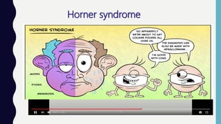 Horner syndrome
 Monocular loss of sympathetic innervation to the eye.
 Loss of function in all of the ocular structures that are sympathetically controlled.
 Pupil is smaller, but the light reaction remains normal.
 A ptosis of the upper lid, caused by paresis of muller’s muscle.
 A small elevation of the lower lid.
 Apparent enophthalmos due to narrowing of the palpebral fissure.
 Impaired sweating and temperature regulation in the face: if the site of damage
to the sympathetic path lies proximal to the branching of the fibres.
 