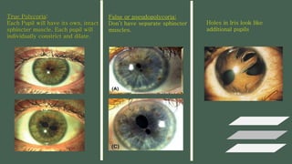 True Polycoria:
Each Pupil will have its own, intact
sphincter muscle. Each pupil will
individually constrict and dilate.
False or pseudopolycoria:
Don’t have separate sphincter
muscles.
Holes in Iris look like
additional pupils
 