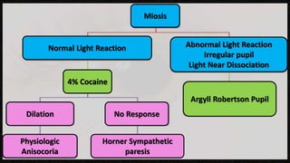 4% Cocaine
Physiologic
Anisocoria
No ResponseDilation
Horner Sympathetic
paresis
Argyll Robertson Pupil
Abnormal Light Reaction
Irregular pupil
Light Near Dissociation
Normal Light Reaction
Miosis
 