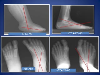 Talo-calcaneal angle (lat stress) 25-40 °