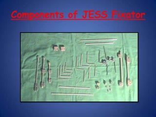 IndicationsDrop out of  conservative treatmentRecurrence after earlier surgical releaseKnown resistant cases- severely contracted foot, AMC, Congenital band syndrome.Late presentation to treatmentAdjunct to surgical treatment -for realignment of skeleton to minimise bone resection and shortening of the foot