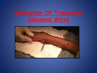 Creations Of HoldsThe tibial holdThe Metatarsal holdThe Calcaneal holdTHE CONNECTION BETWEEN HOLDSThe Tibio-metatarsal connection  The Calcaneo-Metatarsal connection  The Tibio-Calcaneal connectionTOE  SLING ATTACHMENT-provides dynamic traction to prevent flexion of the toes as deformity gradually corrects