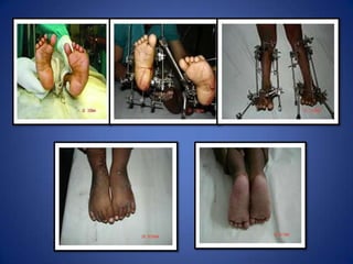 Static period: 3-6 weeks